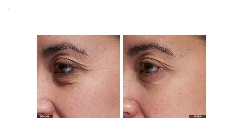 لیزر ضد چروک دور چشم تریا مدل SmoothBeauty